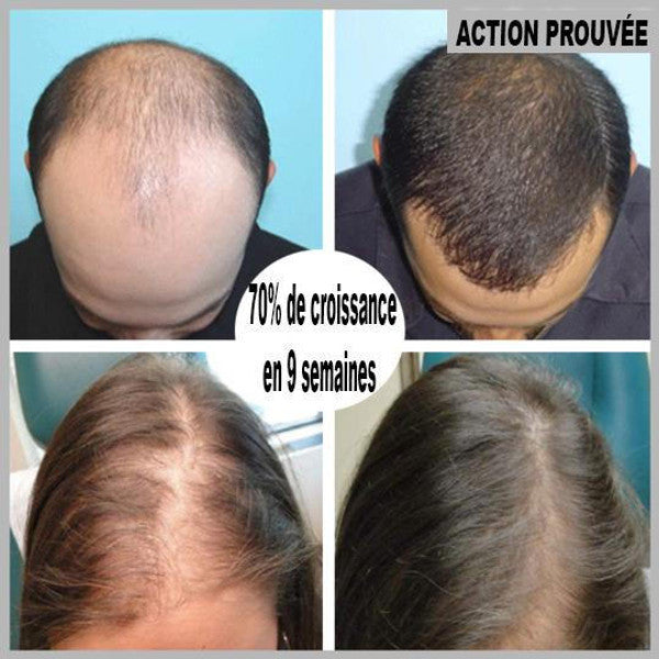 Serum de repousse de cheveux