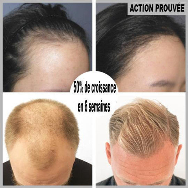 Serum de repousse de cheveux